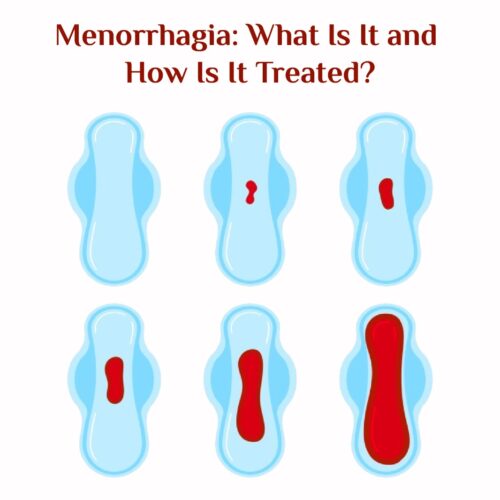 Menorrhagia: What Is It and How Is It Treated?